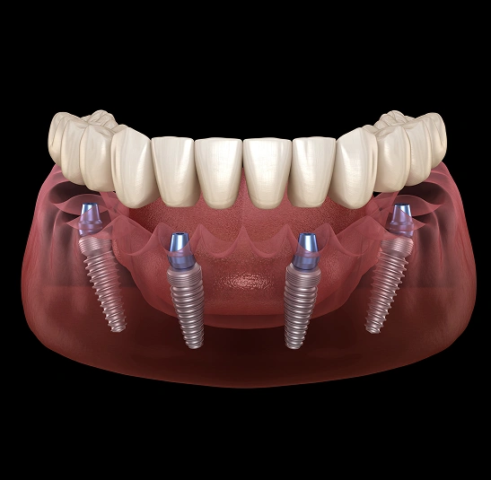 all-on-4-dental implants in el monte