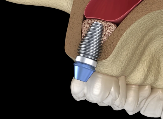 bone grafting and sinus lifts in el monte