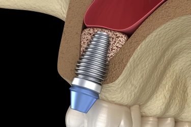 bone grafting and sinus lifts in el monte