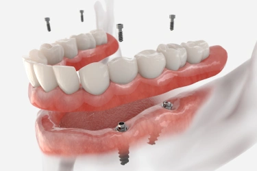 extractions maxillofacial surgery in el monte