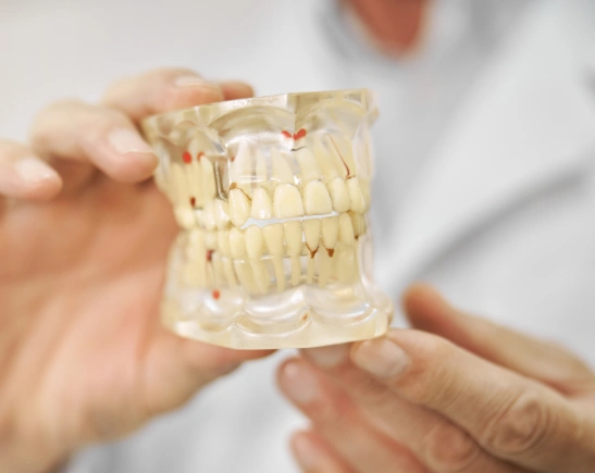 full arch dental implants in el monte