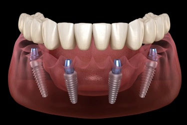 full arch dental implants in el monte