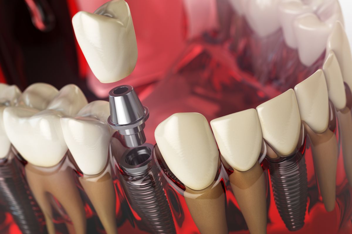 how to care dental implants