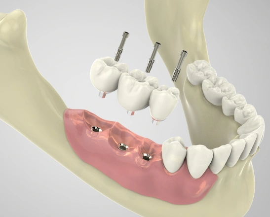 implant supported dental bridges in el monte