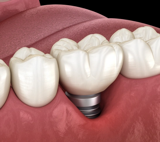 mini dental implants in el monte