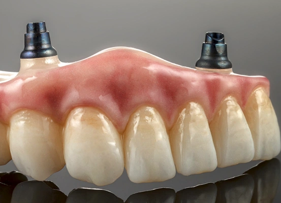 renew dental surgery for implant supported bridges