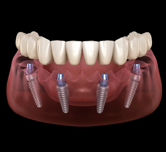 teeth-in-a-day dental implants in el monte