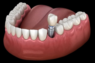 teeth in a day dental implants in el monte