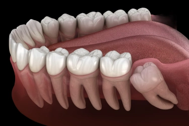 wisdom teeth management in el monte
